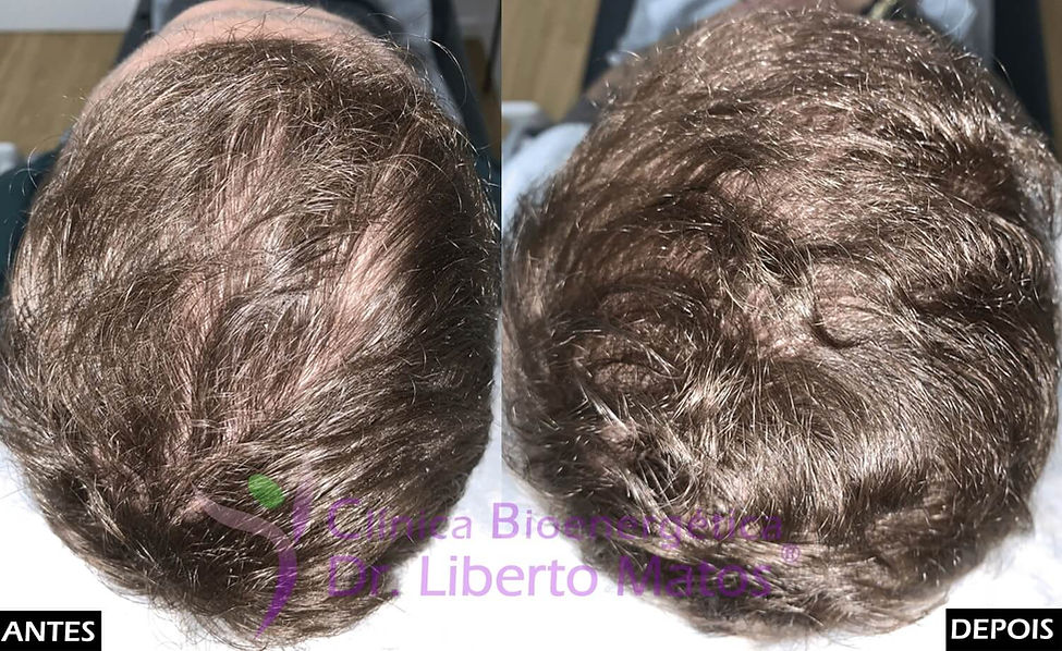 Resultados do tratamento avançado para alopecia masculina. Regeneração folicular e aumento da cobertura capilar na zona superior do couro cabeludo através de estimulação direta na raiz