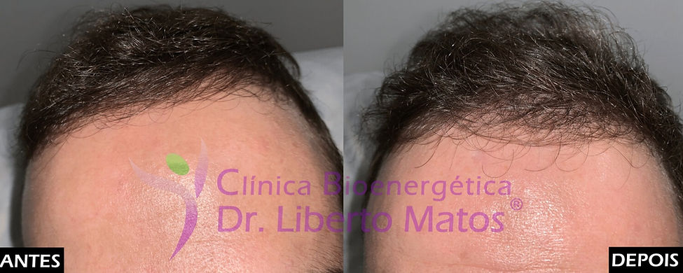 volução clínica de antes e depois na recuperação da linha frontal e entradas típicas da calvície masculina, recorrendo a nutrição folicular e microagulhamento capilar