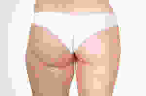 Mesoterapia Celulite