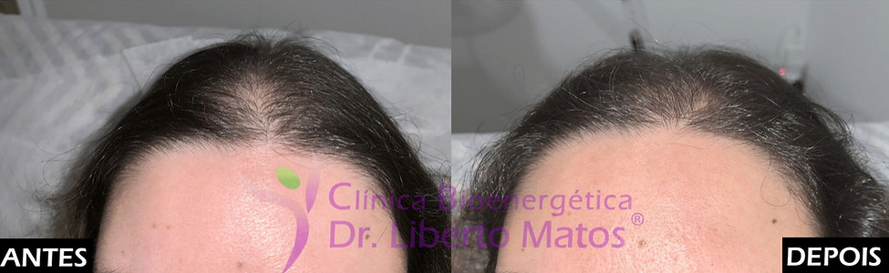 Comparação clínica de antes e depois do tratamento para queda de cabelo e rarefação na linha frontal em mulher, utilizando os protocolos avançados das Clínicas Dr. Liberto Matos