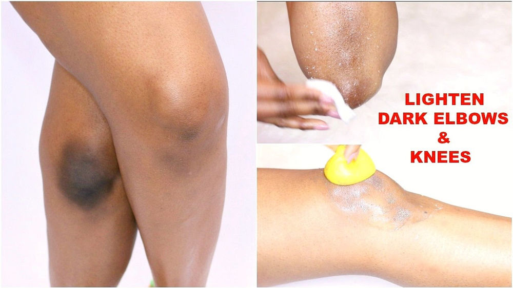 5 Tips To Lighten Dark Elbows And Knees By Dr Meenu Sethi Skyn Stories Clinic