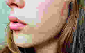 Acne Treatment in Gurgaon (Skny Stories By Dr. Meenu Sethi)