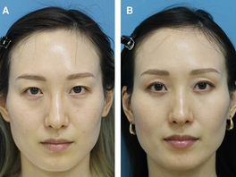 Modified Transconjunctival Lower Blepharoplasty Method For Asian Eyes