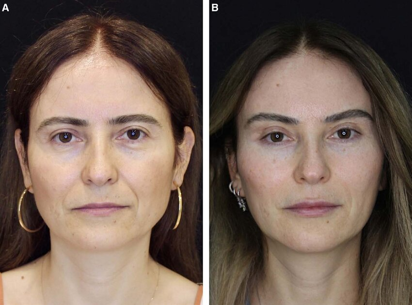 Source: Kul, Zekeriya, Eryilmaz, Erhan, & Özer, Emre (2025). Transtemporal Endoscopic Deep Plane Face Lift. Plastic and Reconstructive Surgery – Global Open, 13, e6461. https://doi.org/10.1097/GOX.0000000000006461
