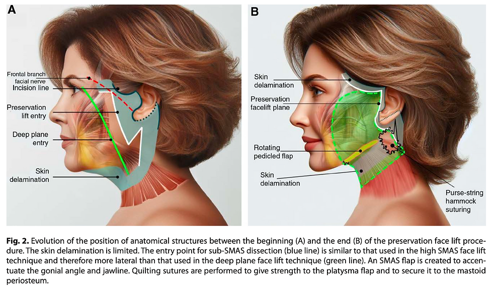 Source: Sadati K, Mathieu O, Cetrulo CL Jr, Lellouch AG. Advancements in Face Lift Techniques: Preservation Face Lift With a Rotating Pedicle Flap. Plast Reconstr Surg Glob Open. 2025 Mar 18;13(3):e6619. doi: 10.1097/GOX.0000000000006619. PMID: 40104381; PMCID: PMC11918738.
