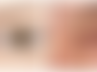 The Five-Step Medial Epicanthoplasty for Asian Patients