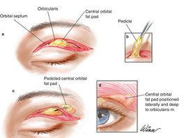 Non-Surgical Facelifting: 8 Common Complications & How to Manage It