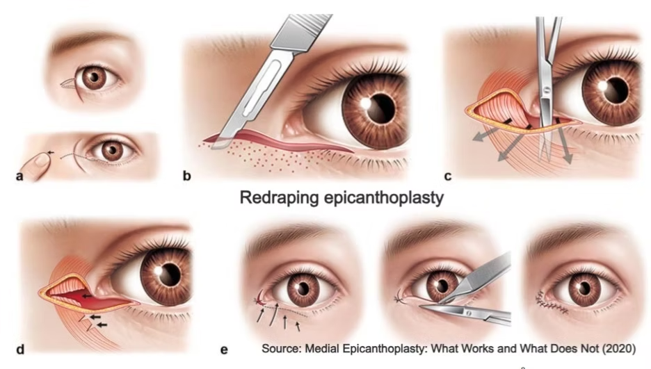 Source: Medial Epicanthoplasty: What Works and What Does Not (2020)