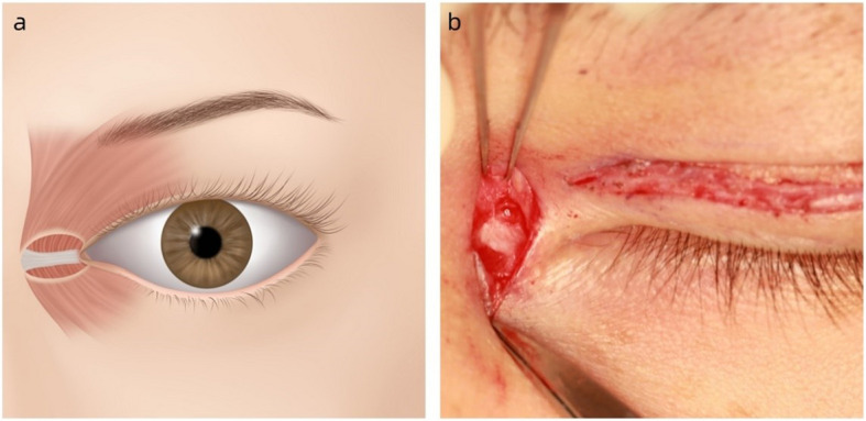 Source: Chen J, Zhang J, Xi W, Chen W, Yang F. The five-step medial epicanthoplasty: simple and standardized. [BMC Ophthalmol. 2025;]. PMID: 40375074.
