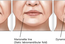 Marionette Lines Injection Techniques: A Multimodal Approach