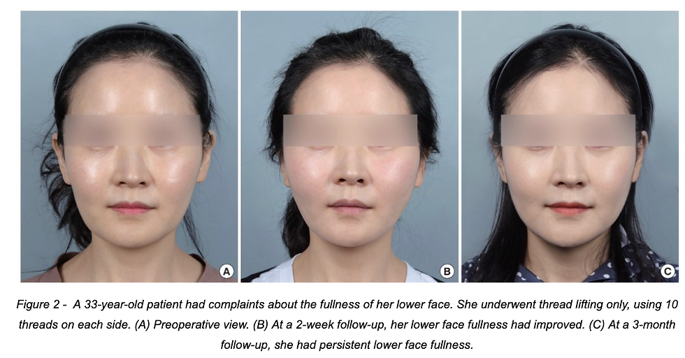 Source: Bae, K. I., Han, D. G., Kim, S.-E., & Lee, Y. B. (2019). Minimally invasive facial rejuvenation combining thread lifting with liposuction: A clinical comparison with thread lifting alone. Archives of Aesthetic Plastic Surgery, 25(2), 52–58. https://doi.org/10.14730/aaps.2018.01550