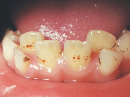 Sudden Brown Stains on Teeth - All you need to know!