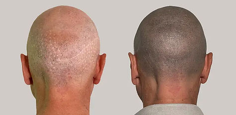 SMP for Scarring