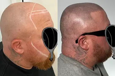 Beard tattoo transformation using Scalp Micropigmentation – before and after results enhancing beard fullness by Hair Ink SMP Gold Coast