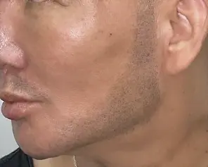 Beard tattoo after Scalp Micropigmentation – defined and fuller beard appearance by Hair Ink SMP Gold Coast
