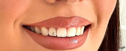 paziente con sorriso perfetto Hollywood Smile e faccette dentali a Tirana