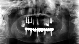 Full arch implant placement on the mandible using Simplant software
