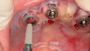 Immediate implant placement using the Neo NaviGuide in the maxillary anterior site