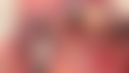 Immediate implant placement using the Neo NaviGuide in the maxillary anterior site