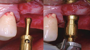 8 Years Follow-up Case of Class III CMI/CM Fixation in the Maxillary 1st and 2nd Molar Area