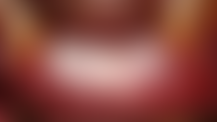 Implant therapy for lower mandibular incisors: Immediate implant placement and GBR