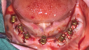 Immediate placement and loading in the mandible with the CMI IS II active implant