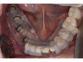 Various Implants Placement using Neo NaviGuide System