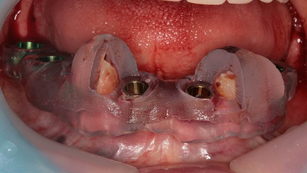 Punching & flapless surgery of mandibular multiple case with Neo NaviGuide