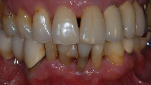 Utilization of ‘PickCap’ Impression Kit with mandibular anterior restorations