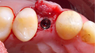 Sinus graft procedure in the crestal approach