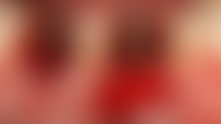 Esthetic placement of S-Mini Onebody Implant in the anterior mandible