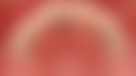 Distal Extension Removable Partial Denture with implant-supported surveyed FPD