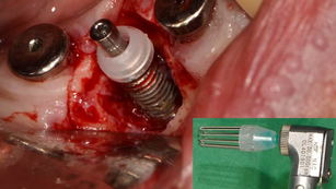 Periimplantitis treatment using i Brush and R Brush