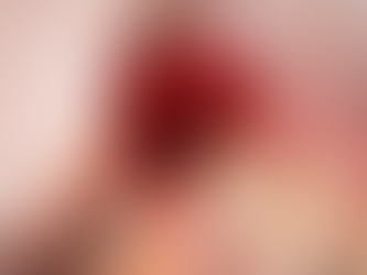 #16 implant placement with sinus elevation (without bone graft)