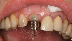 Immediate implant placement on right maxillary central incisor with IS-II Active implant