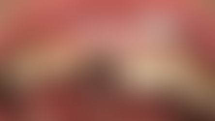 Immediate implant placement on right maxillary central incisor with IS-II Active implant