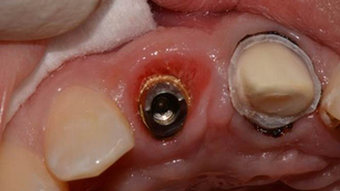 SOCKET SHIELDING IMMEDIATE IMPLANT USING NEOBIOTECH IS-II ACTIVE FIXTURE