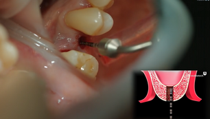 Sinus Membrane Elevation through the Crestal Approach