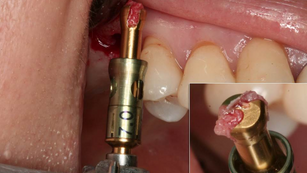 Wide implant placement in the sinus-lifted maxilla and native bone