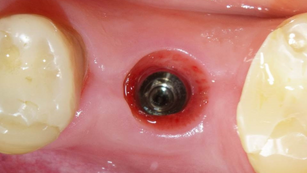 6 months follow-up of #36 implant placement