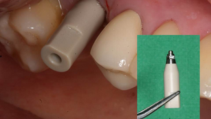 Intraoral Scanning System using a Scanbody