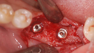 The staged approach on atrohpic ridge using NeoBiotech IS II active fixture and nonresorbable membra