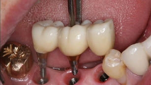 Implant placement with IS III active fixtures in the posterior mandible