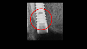 Removal of a fractured implant screw