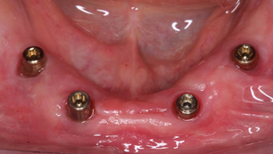 HIGHBRIDGE CASE: 4 IS-II Active implants (Neobiotech) in the edentulous mandible.