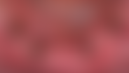 HIGHBRIDGE CASE: 4 IS-II Active implants (Neobiotech) in the edentulous mandible.