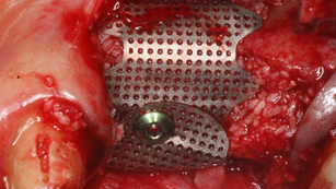 Vertical bone augmentation with Tent screw and CTi-mem