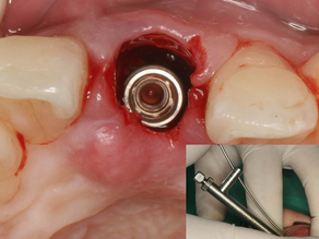 Socket shield technique: Immediate implant placement and buccal tissue preservation