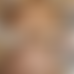 Botox injections Bozeman, MT