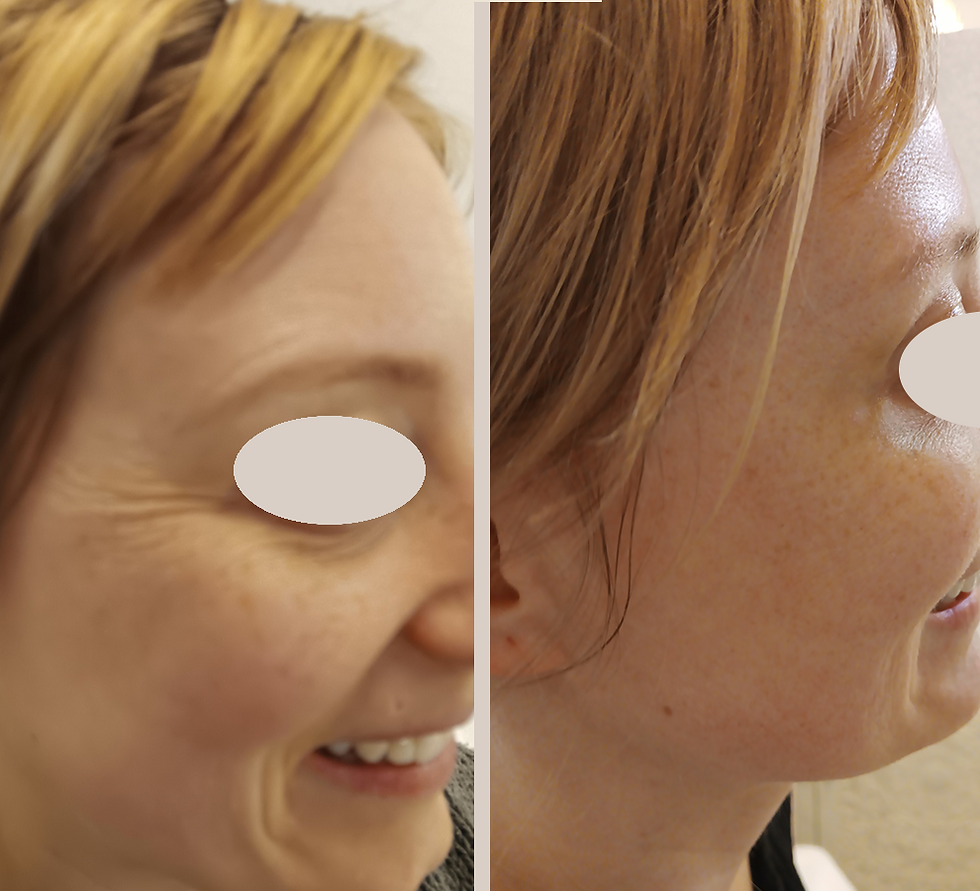 crows feet injections right side